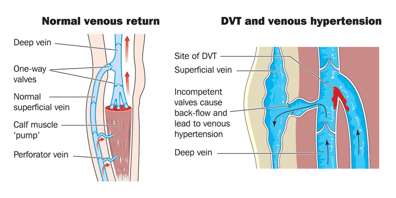Blog-DVT