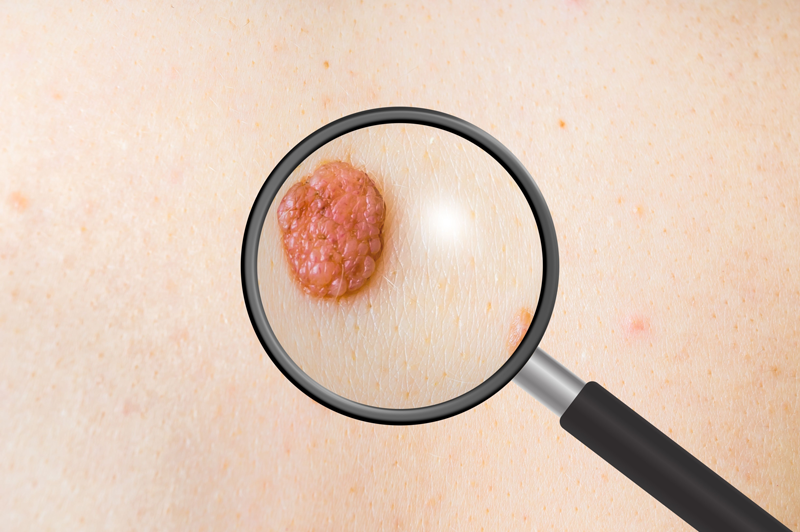 Blog-Melanoma-Signs