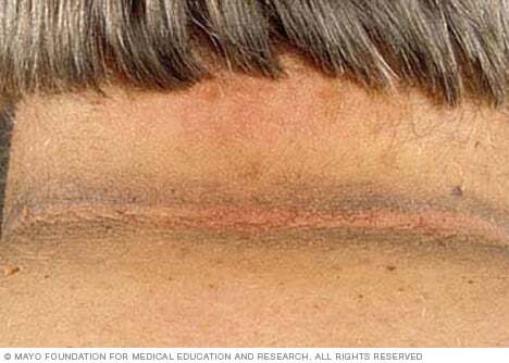 Photo of acanthosis nigricans