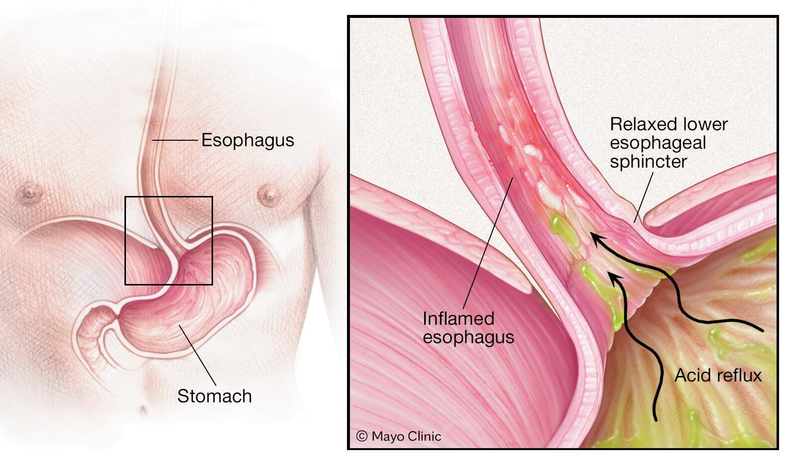 How GERD occurs in the esophagus