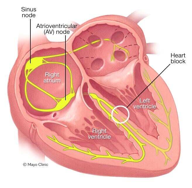 Bundle branch block