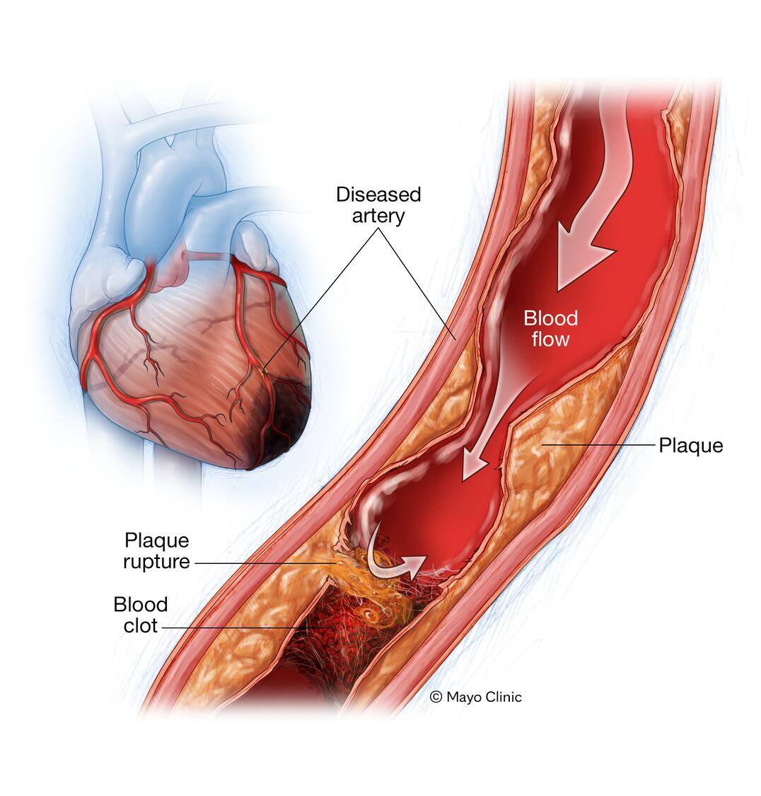 Illustration showing causes of myocardial ischemia