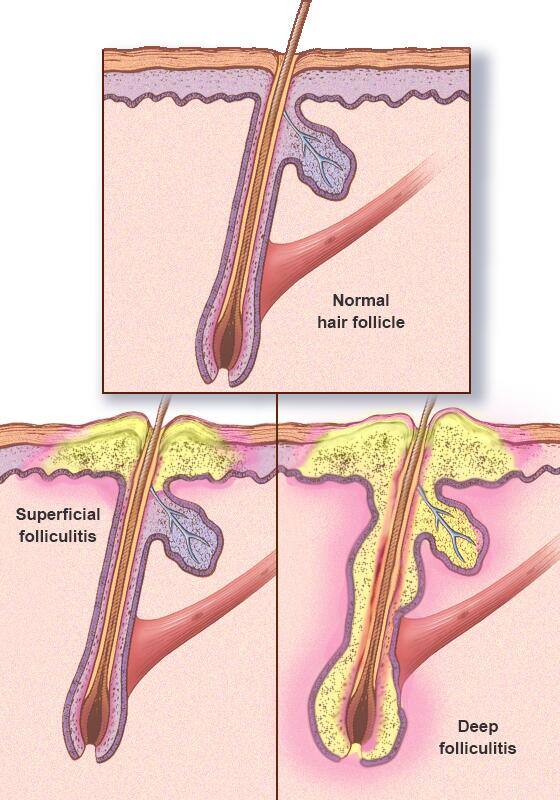 Folliculitis 