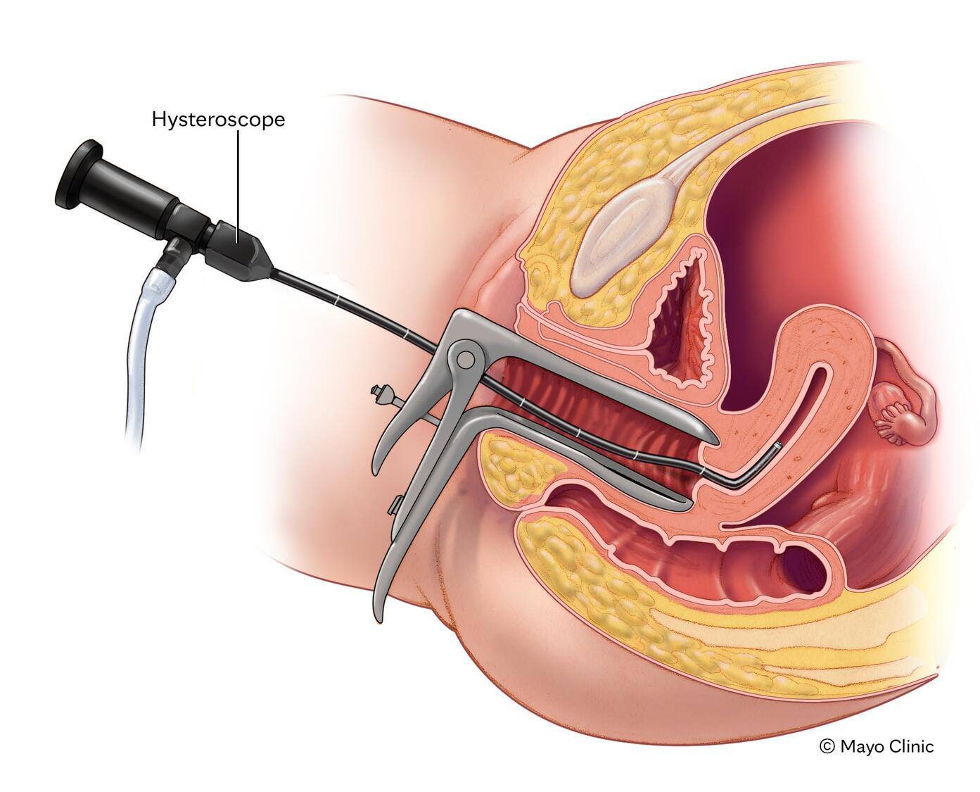 Hysteroscopy
