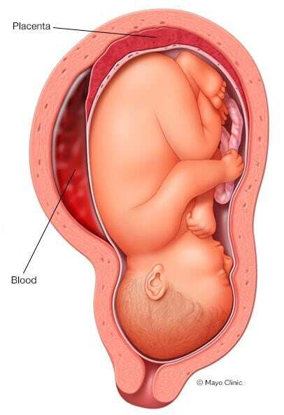Placental abruption