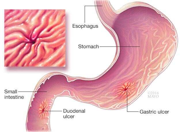 Ulcers