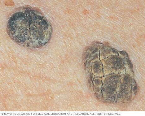 Close-up image of seborrheic keratoses