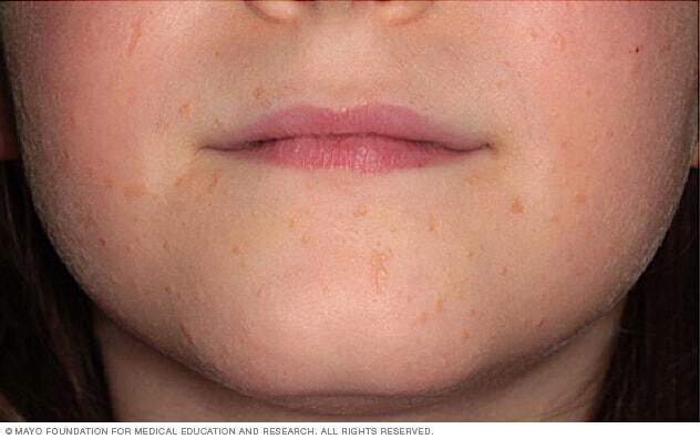 Flat warts