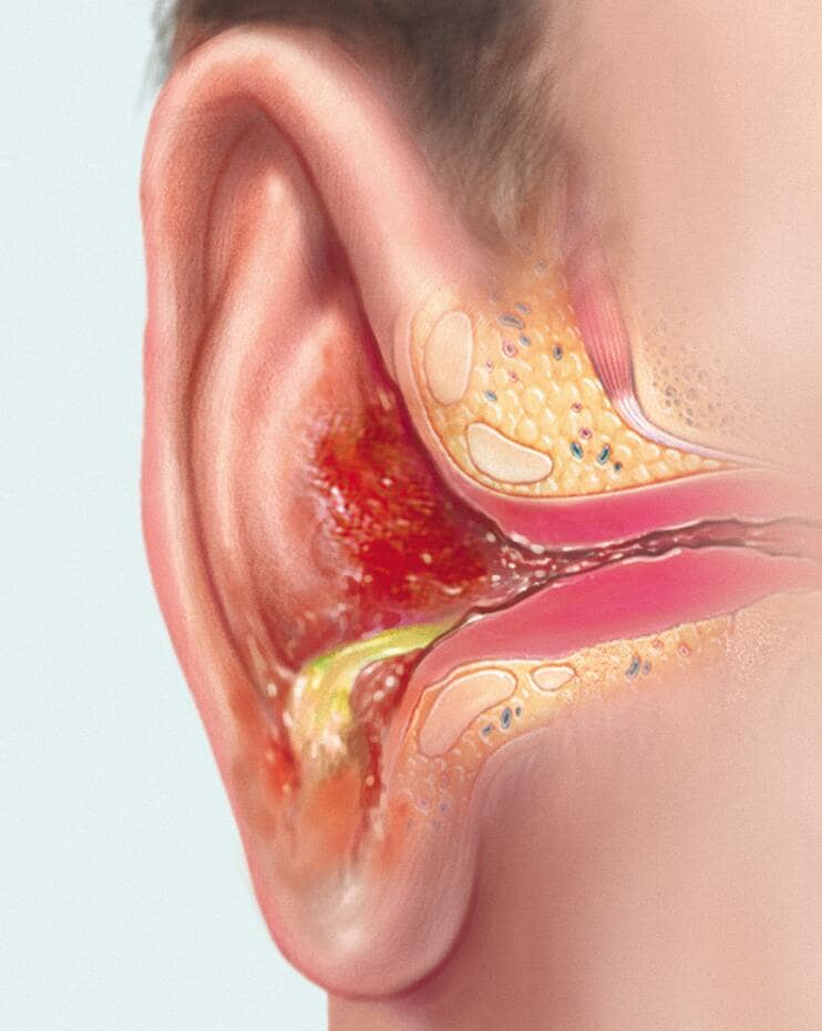 Outer ear infection