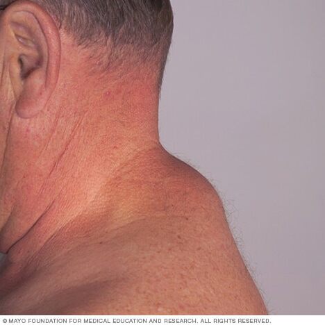 Image of a lipoma