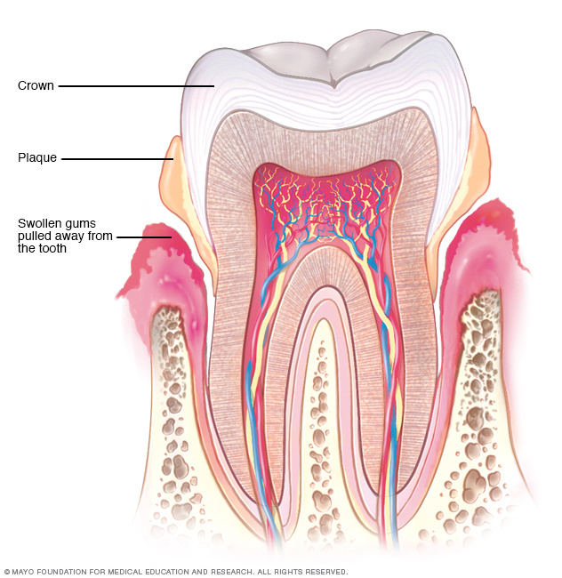 Periodontitis