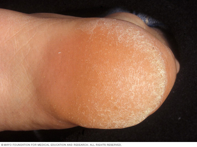 A callus