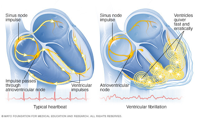 Ventricular fibrillation