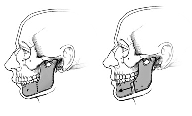 The lower jaw is divided and the front section is moved forward or backward and secured with plates and screws.