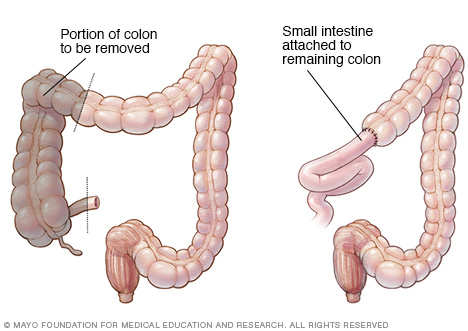 Illustration showing right hemicolectomy