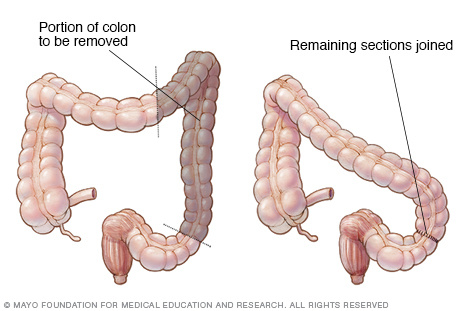 Illustration showing left hemicolectomy