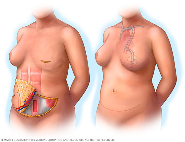 Illustration showing a free TRAM flap procedure