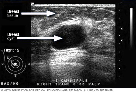 Ultrasound image of a breast cyst