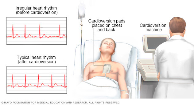 Person undergoing cardioversion