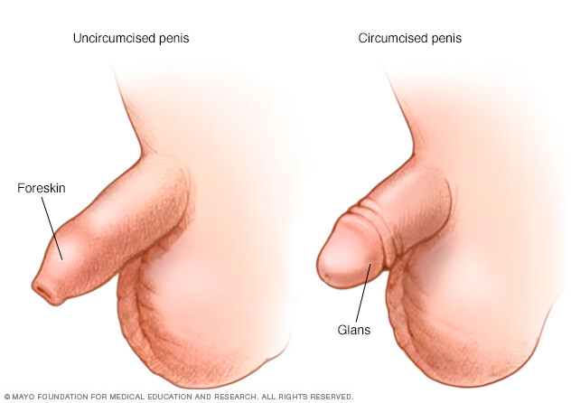 Penis before and after circumcision