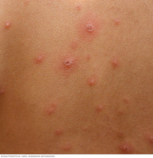 Chickenpox