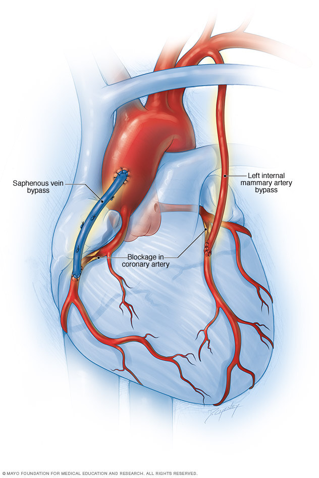 Coronary Artery Bypass Surgery All You Need To Know
