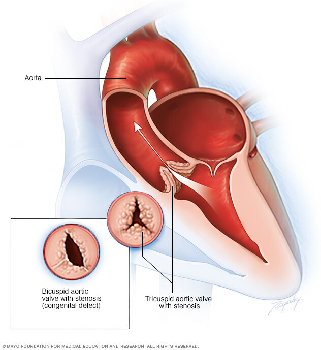 Aortic Valve Stenosis Aortic Valve Stenosis