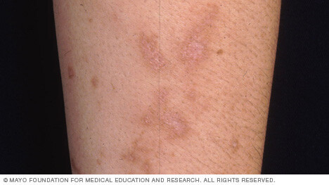 An example of a skin reaction to wild parsnip