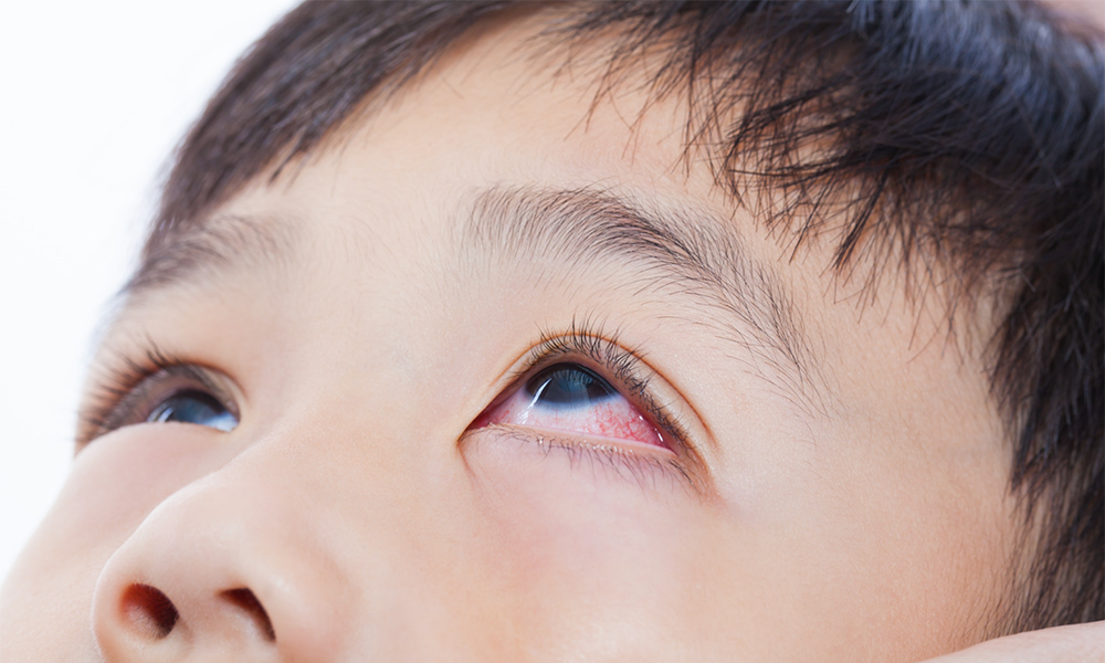 Pinkeye